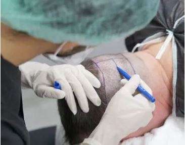 Pusat Pemindahan Rambut Hermest, Turki