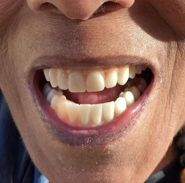 ፍጹም ፈገግታ ጥርስ - ክላርሽም