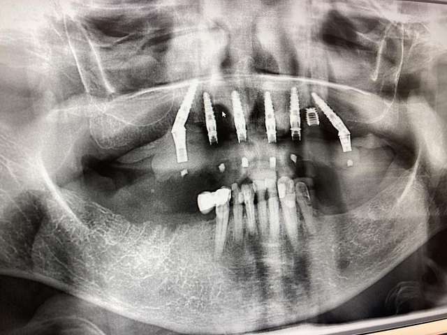 ፍጹም ፈገግታ ጥርስ - ክላርሽም