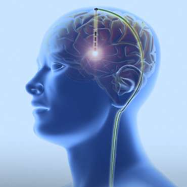 ጥልቅ የአእምሮ ማነቃቂያ(ዲቢኤስ) ቀዶ ጥገና