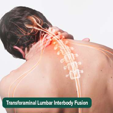 ትራንስፎርሜናል ላምባር ኢንተርቦል ፊውዥን (TLIF))