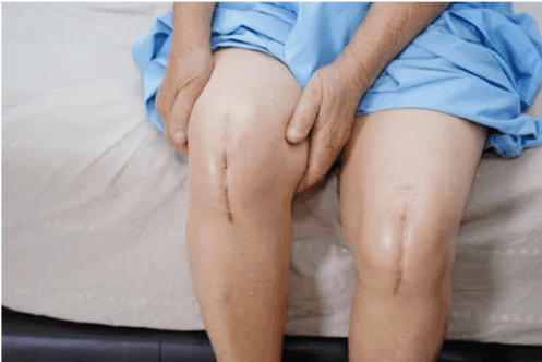 استبدال الركبة الكلي (ثنائي))