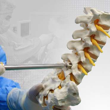 دمج الفقرات القطنية عبر الجسم عبر الثقب (TLIF))