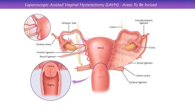 ላስትሮስኮፕቲክ የሴት ብልት / Systractomy (LAVH)