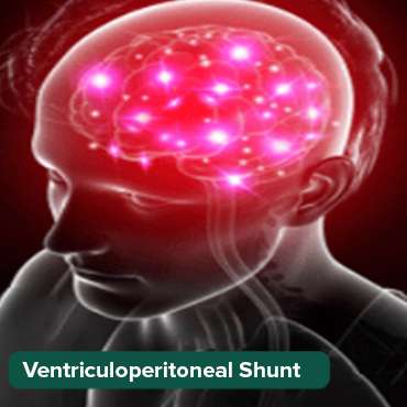 ventricullopritonal (VP) ማፍሰስ