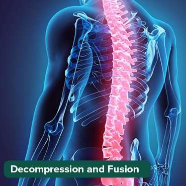 ডিকম্প্রেশন এবং ফিউশন