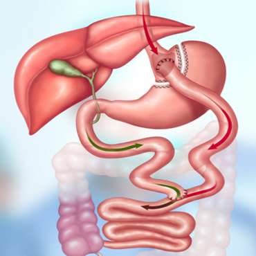 የጨጓራ እጢ ማለፍ