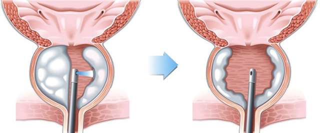 هولميوم ليزر إنشاء البروستاتا (هوليب)