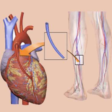 የልብ ወሳጅ ቧንቧ ማለፍ (CABG))