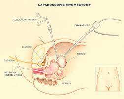 ላፓሮስኮፒክ ሳይስቴክቶሚ